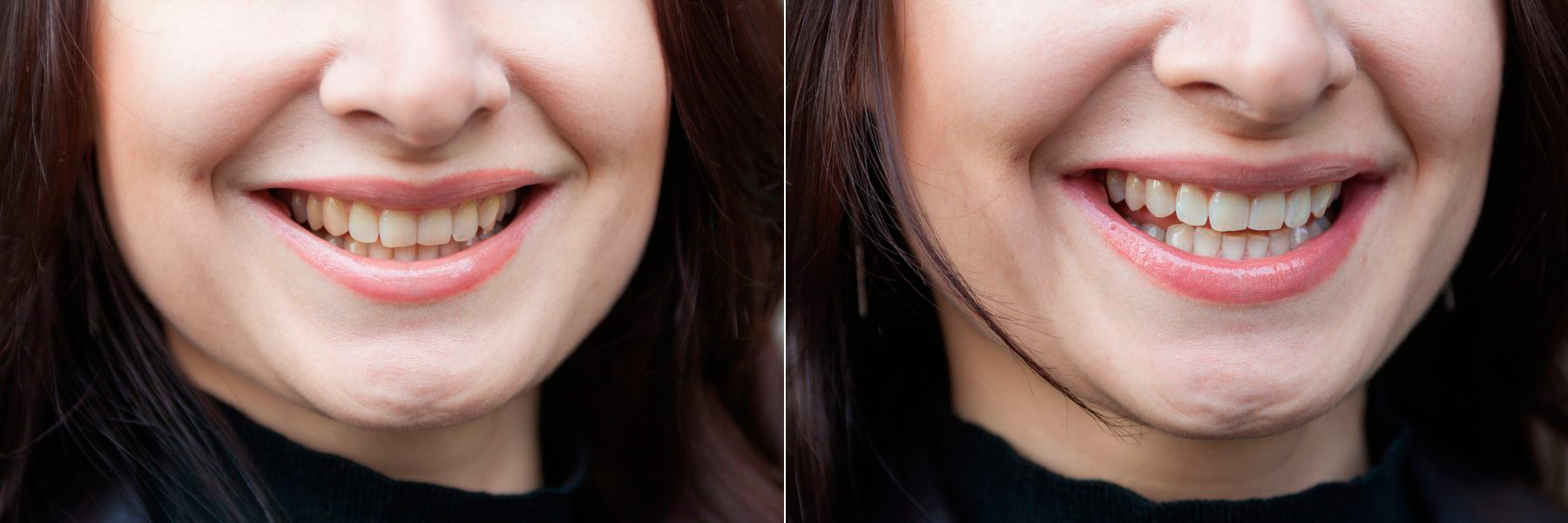 Зубы до и после отбеливания фото девушек ингалятор что заливать при насморке
