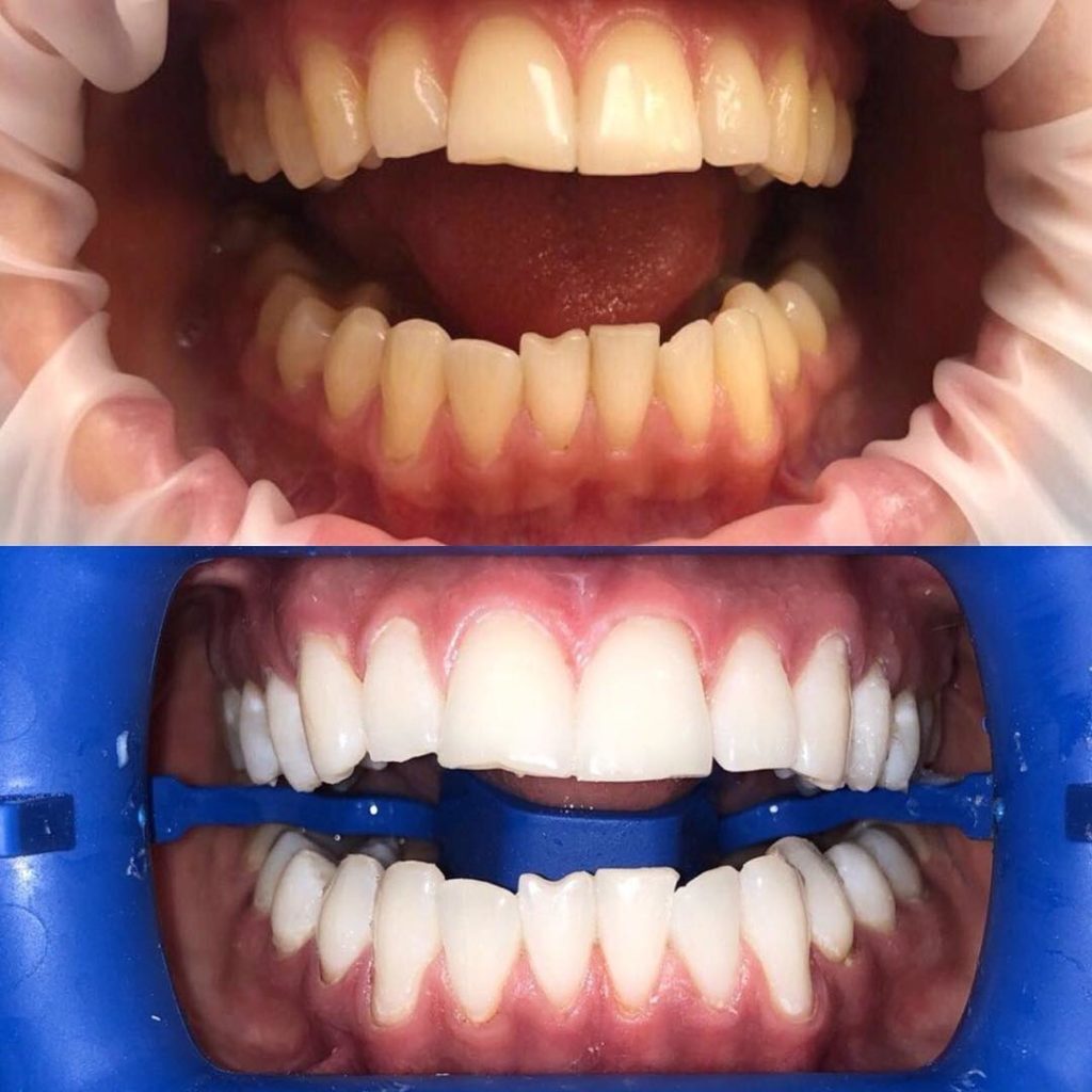Зубы после процедуры отбеливания