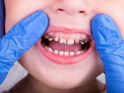 Нужно ли удалять гнилые молочные зубы?
