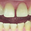 Обращение пациента в клинику по поводу перелома коронковой части 21 зуба
