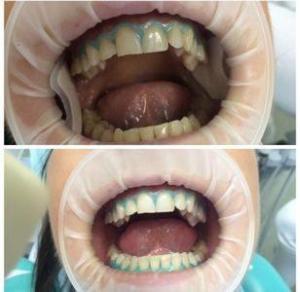 Профессиональное отбеливание зубов Opalescence