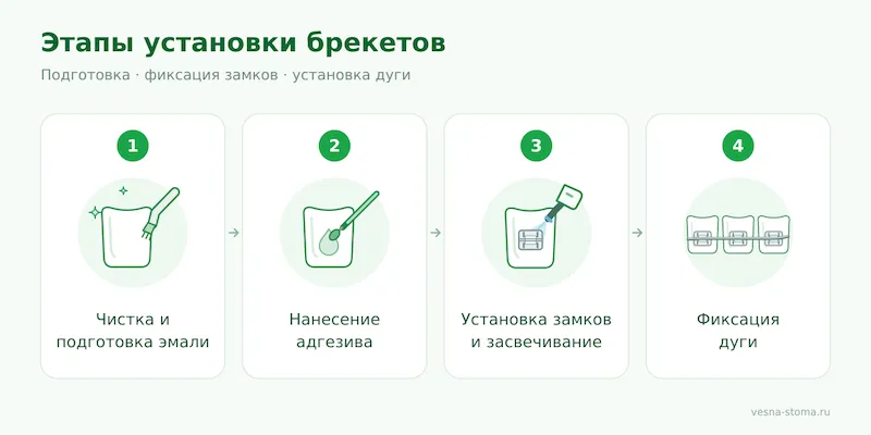 Этапы установки брекетов: подготовка, фиксация замков, установка дуги