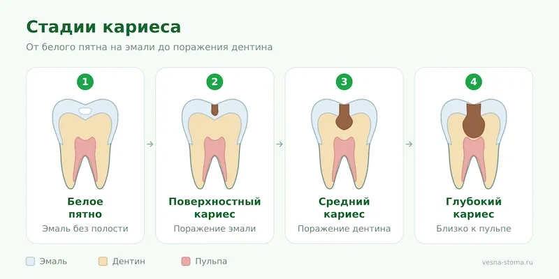 Стадии кариеса: от белого пятна на эмали до поражения дентина