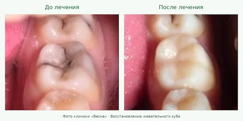 Жевательный зуб до и после лечения кариеса композитной пломбой