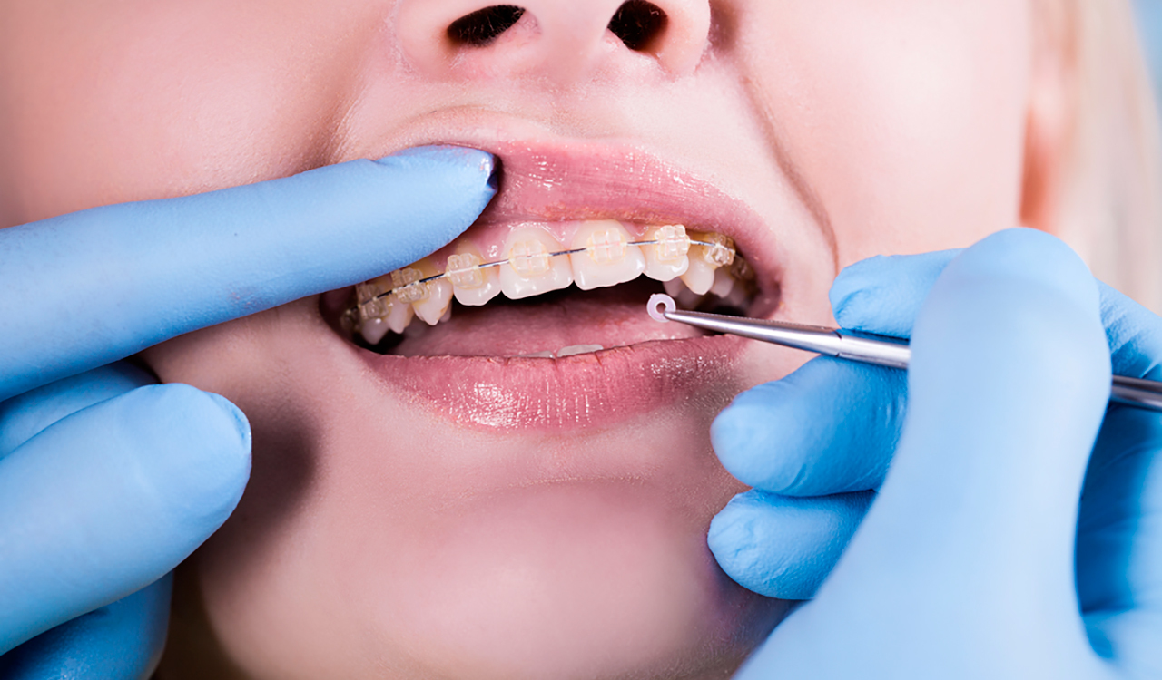 Лечение полости рта и зубов. Стоматология брекеты. Ортодонтия в стоматологии. Зуба стоматология брекеты. Стоматология ортодонт.