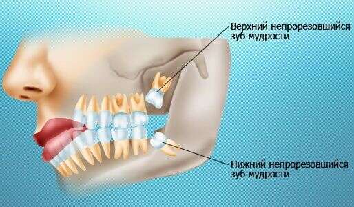 Зуб мудрости: режется и растет восьмерка, лечить или удалять в стоматологии