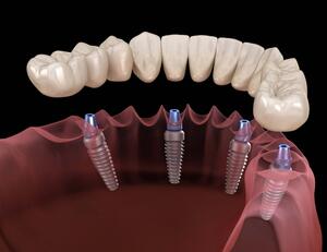 Как выглядит протезирование зубов ?
