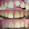 Обращение пациента в клинику по поводу перелома коронковой части 21 зуба