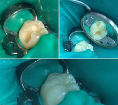 Диагноз: кариозное поражение на жевательной и боковой поверхности 46 зуба